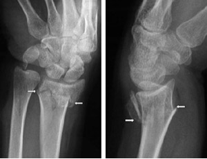 DistalFracture1