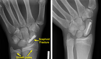 ScaphoidFracture1