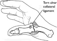 ThumbUlnar